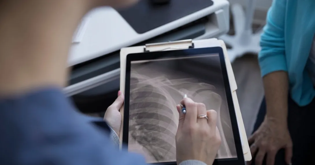 پوکی استخوان