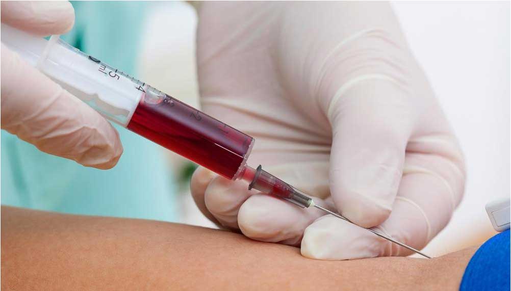 تأیید FDA برای آزمایش خون نوآورانه تشخیص زودهنگام آلزایمر